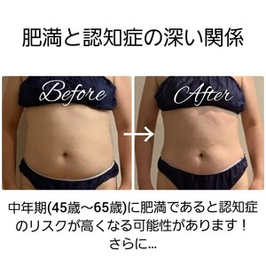 肥満と認知症の深い関係（＞＜）